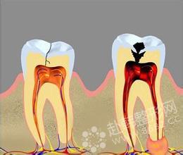 韩国纽菲斯:牙神经痛要做根管治疗吗?,牙齿修