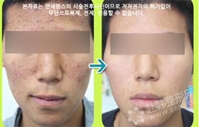 面部皮肤治疗前后对比