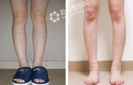 韩式微创瘦小腿术前后对比照