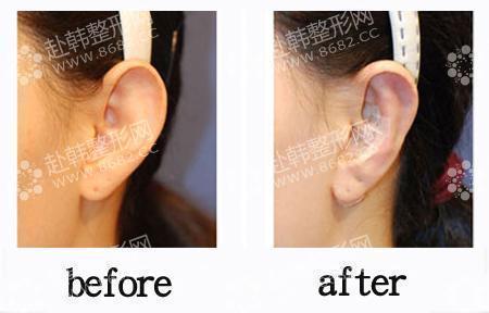 耳廓再造术