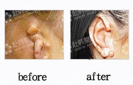 耳廓再造术