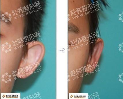耳部整形对比照