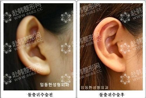 耳部整形对比照