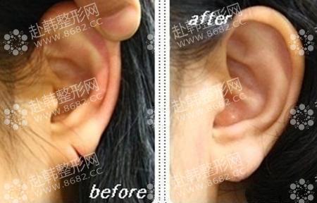 耳垂受损的修补