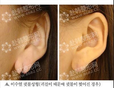 耳残整形对比照