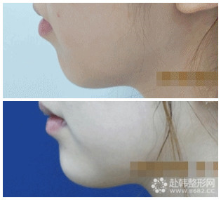 下巴整形对比照