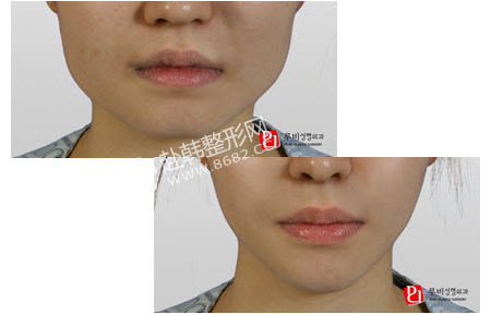 v-line整形前后对比照片