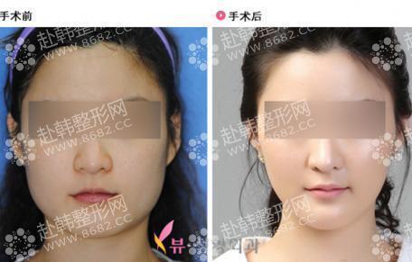 面部轮廓整形前后对比照