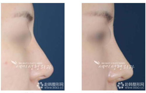鼻部整形前后对比照片
