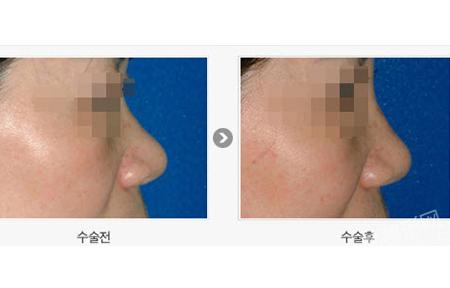 隆鼻整形手术前后对比照