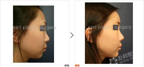 鼻部整形手术对比照