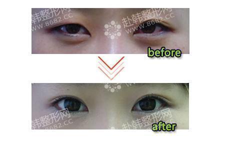 双眼皮手术方法