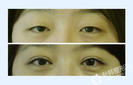 双眼皮+内眼角手术前后对比照