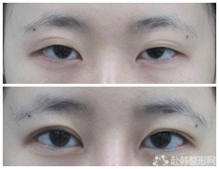 切开法双眼皮对比照