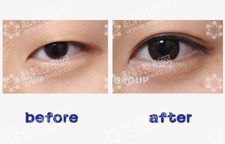 韩国割双眼皮的手术方法