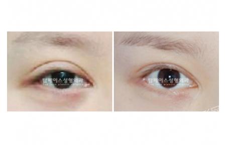 眼部修复手术前后对比照