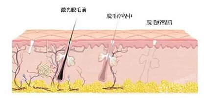 激光脱毛正当时--8个问题,帮你规避常见误区!,光