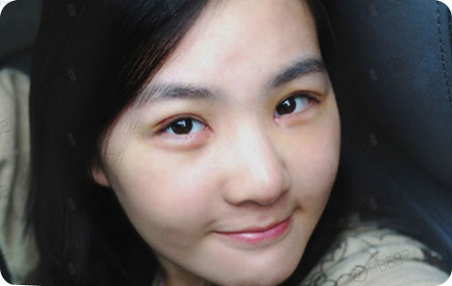 韩式双眼皮手术恢复过程图(真实案例),韩式双眼