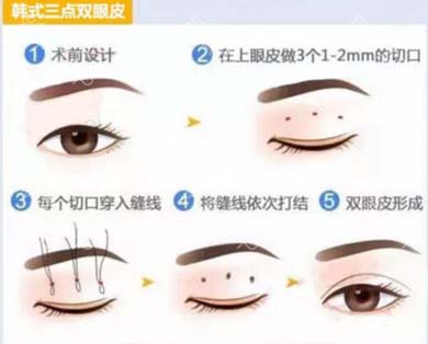 韩式双眼皮手术 韩国微创三点定位双眼皮手术