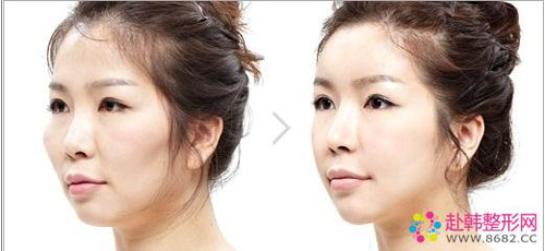 韩式童颜术前后对比