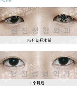 韩式开眼角手术怎么做 韩式无痕开眼角前后对比照