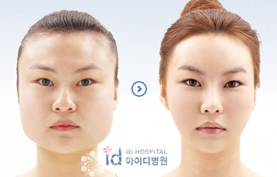 韩国vline手术整形前后对比照片 韩国vline手术对于不对称脸型、长/短脸型、U字型/大宽脸、一字型下巴等都有很好的矫正效果。