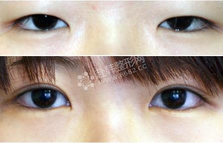 韩式无痕开内眼角的优势 双眼皮+开内眼角前后对比照片