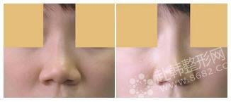 鼻翼缩小对比照，根据不同人的不同情况，鼻翼缩小术的手术方法有所不同