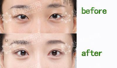 韩式切开双眼皮的适宜人群 切开双眼皮前后对比照