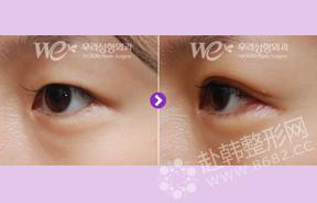 小眼睛变大的方法 韩式无痕开眼角变大眼的效果 开外眼角手术对比照