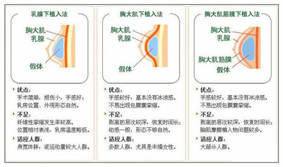 假体隆胸的三种手术切口