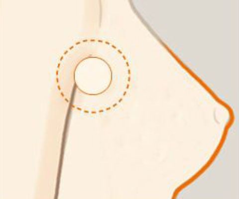 副乳手术图解图片