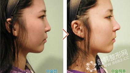 韩国美谈美容整形外科隆鼻对比照片