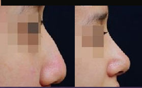鼻樑，鼻尖	鼻翼縮小術