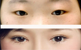 经典韩式双眼皮成形术