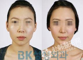 韩式改脸型手术前后