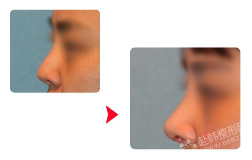 鼻部整形对比照