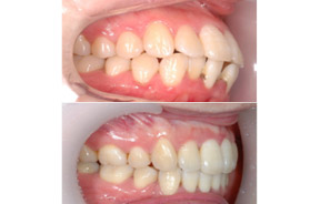 突嘴牙齿矫正前后对比照