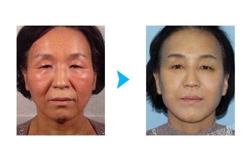 全身健康促进治疗和面部抗老化细胞治疗对比照