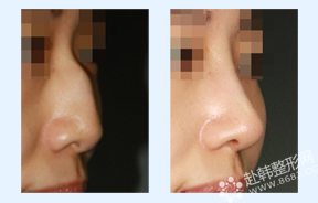 驼峰鼻矫正前后对比照片