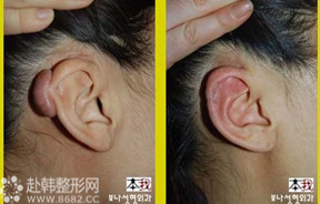 耳部疙瘩祛除对比照