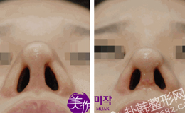 鼻部修复整形对比照