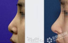 矮鼻整形手术前后对比照