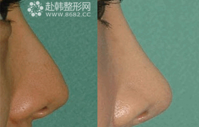 鼻部修复整形对比照