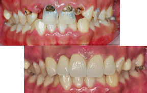 虫牙牙齿矫正前后对比照