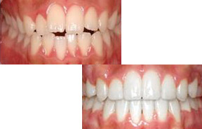 前突牙齿矫正前后对比照