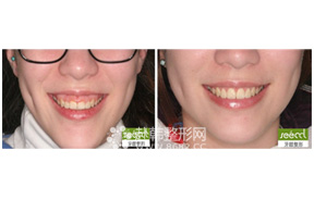 牙齿矫正+牙龈整形前后对比