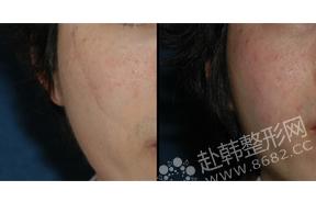 面部疤痕修复手术前后对比照