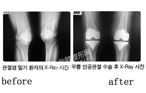 人工膝关节置换术对比照