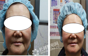 面部提升手术前后对比照